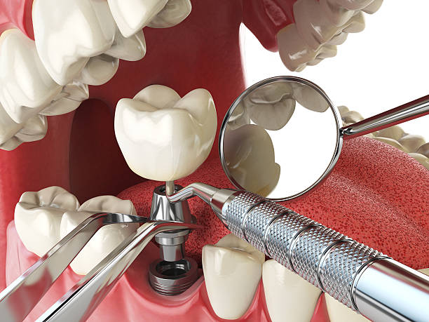 Best Emergency Root Canal Treatment in Mammoth Spring, AR